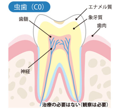 虫歯（CO）