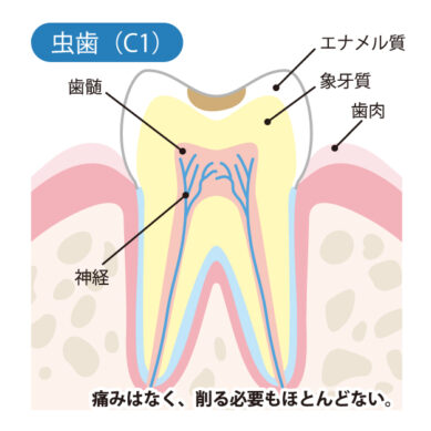 虫歯（C1）