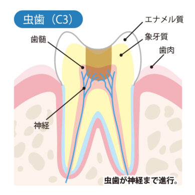 虫歯（C3）