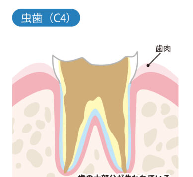 虫歯（C4）