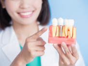 インプラントのイメージ